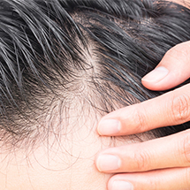 Trapianto di capelli