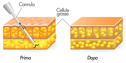 medea chirurgia estetica lipoaspirazione liposuzione tecnica